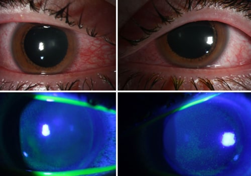 The Benefits of Installing UV Lights in Broward County, FL